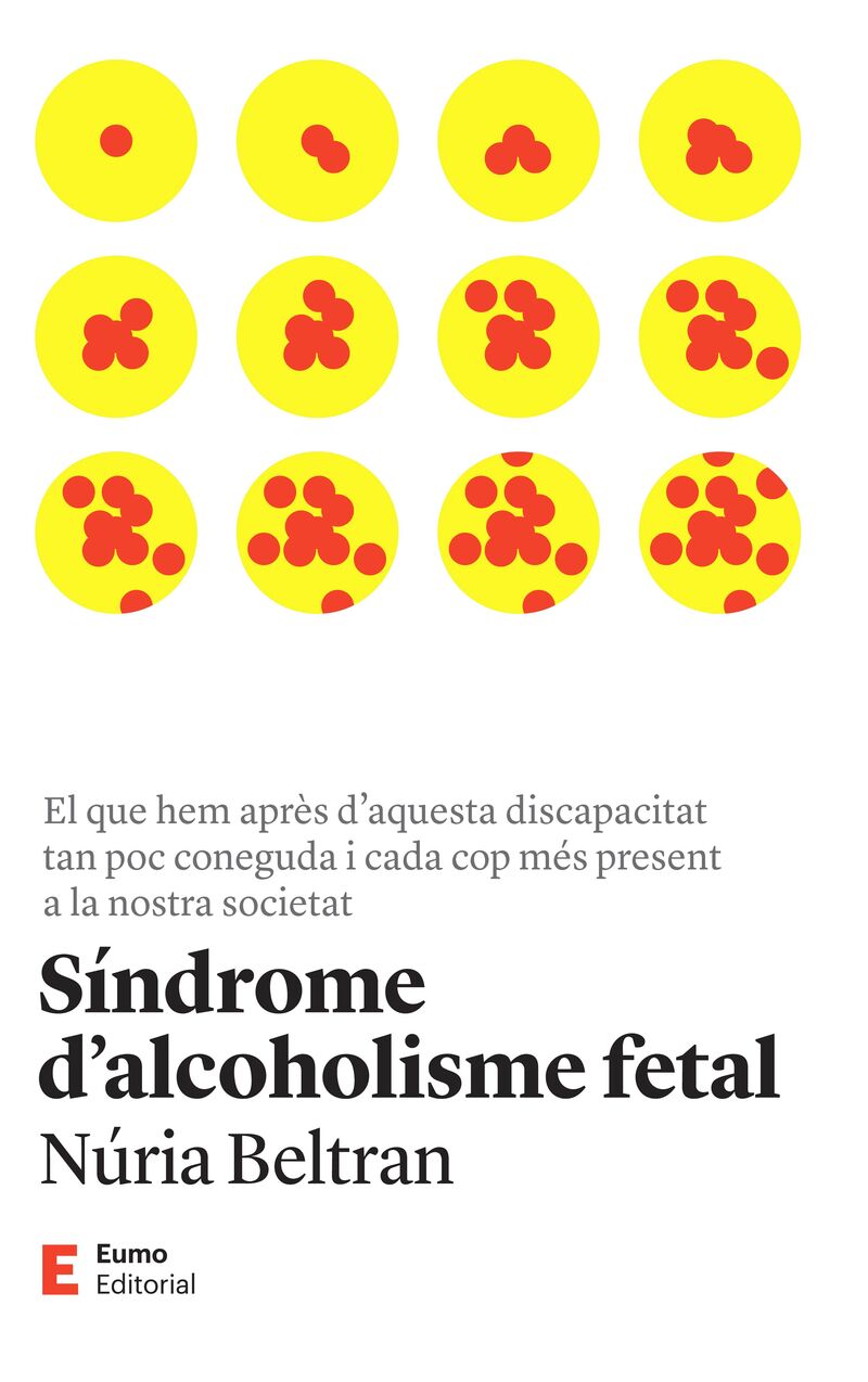 SINDROME D'ALCOHOLISME FETAL